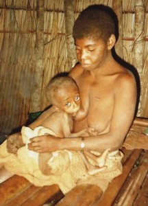 Bébé atteint de malnutrition aiguë dans notre centre de DJOUT au CAMEROUN