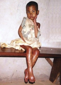 Enfant atteint de KWASHIORKOR dans notre centre de DJOUT au CAMEROUN